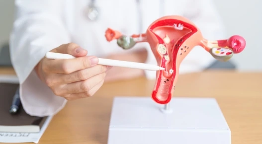Endometriosis
