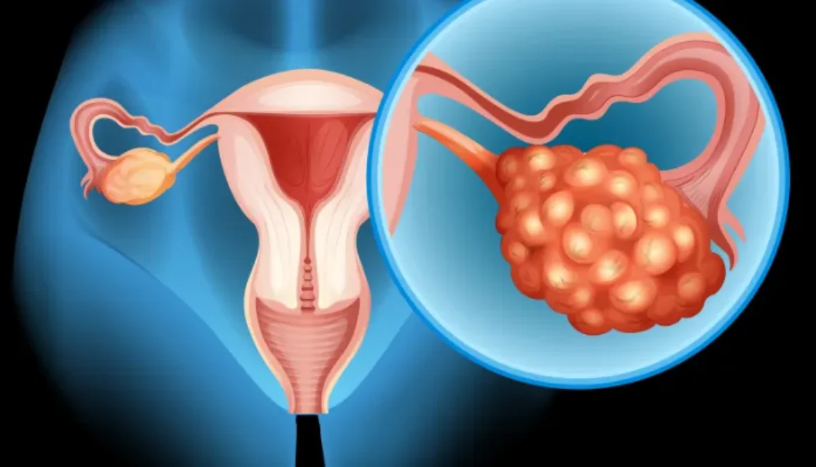 ovarian-cancer-blog-img_4