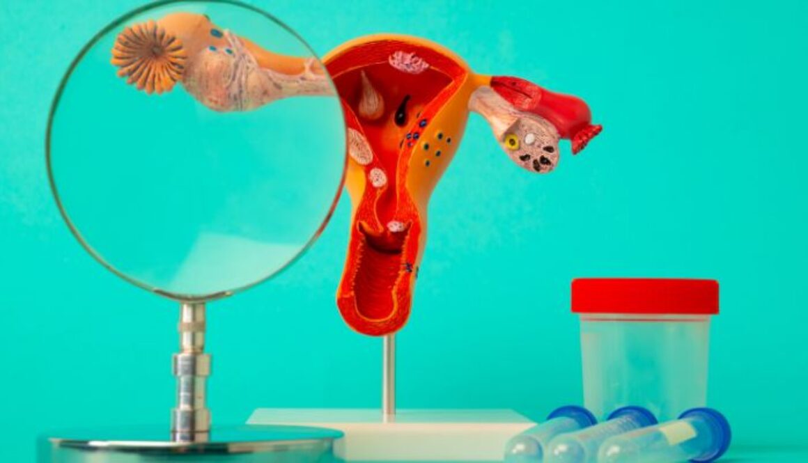 What-is-ovarian-cancer